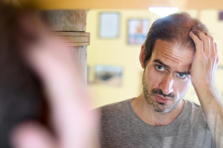 Γιατί η γενετική παίζει σημαντικό ρόλο στην τριχόπτωση